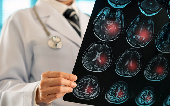 Ischemic stroke, where blood flow is blocked to a portion of the brain, accounts for nearly 90% of all strokes
