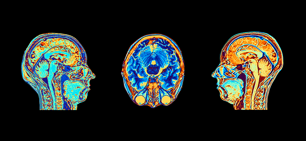 MRI scans of normal brains